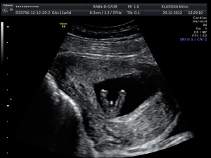 УЗИ во время беременности - Страница 31 Img_20121231_1_131